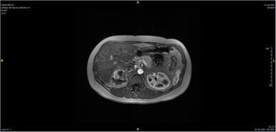 Case Report: Resuscitation of patient with tumor-induced acute pulmonary embolism by venoarterial extracorporeal membrane oxygenation